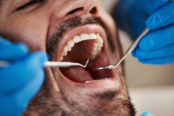 Emergency Treatment for Gum Disease